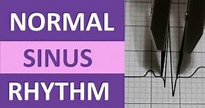 Normal Sinus Rhythm Nursing Made Easy on ECG/EKG Heart Interpretation
