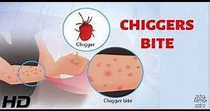 CHIGGERS BITE: Everything You Need To Know
