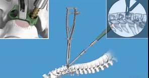 頸椎移位手術, 麻痹, 椎間盤移位治療, 脊骨移位- 微創前頸椎融合手術, Zero P