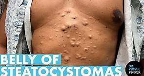 A Belly Full Of Steatocystomas! Dr Pimple Popper Mines a Patient's ...