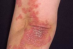 Psoriasis