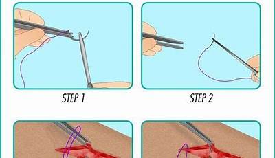 Surgical Suturing Or Wiring Together Of Bones