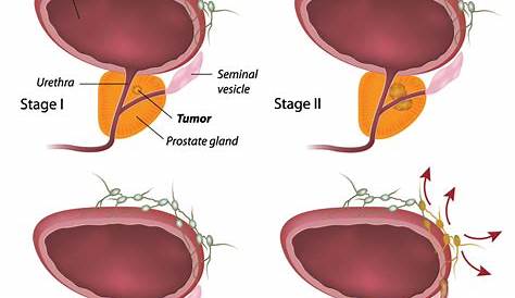 prostate biopsy diagram