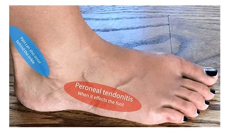 Peroneal Tendonitis - Almawi Limited The Holistic Clinic