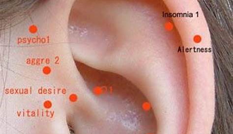 where to place ear seeds for migraines