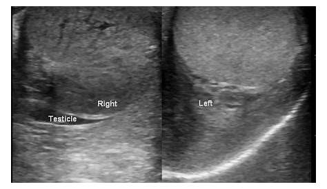 how to diagnose testicular torsion