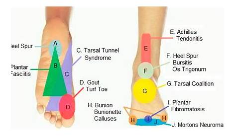 heel pain diagnosis chart