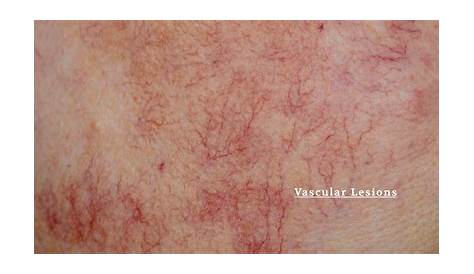 vascular lesions of the skin