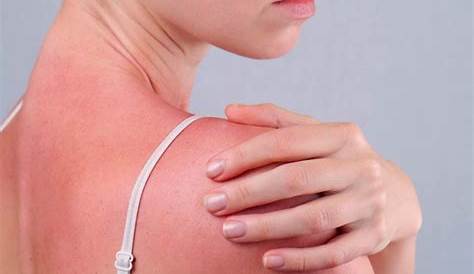 Silent Signs of Sun Poisoning You Need to Know About | Reader's Digest