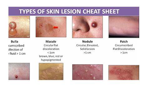 Types of Skin Lesion Cheat Sheet - NCLEX Quiz