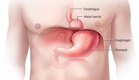 size of a large hernia