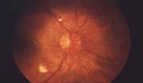 Diabetic retinopathy physical examination - wikidoc