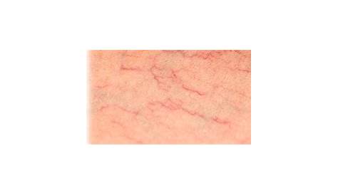 what are vascular lesions