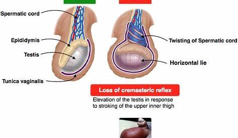 how to identify testicular torsion