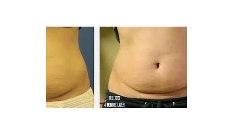 How To Do Coolsculpting