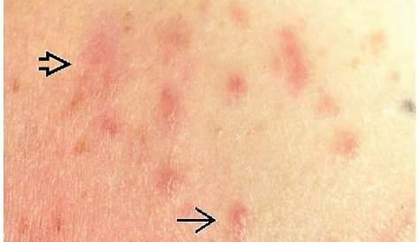 Atypical Vascular Lesions of Skin | Basicmedical Key