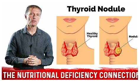 nodule on thyroid size