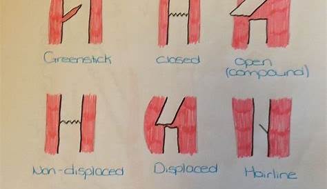 Types Of Fractures Worksheet