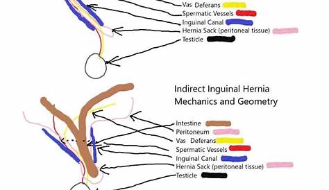 inguinal hernia size chart