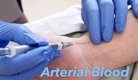 Basic Arterial Blood Gas Interpretation