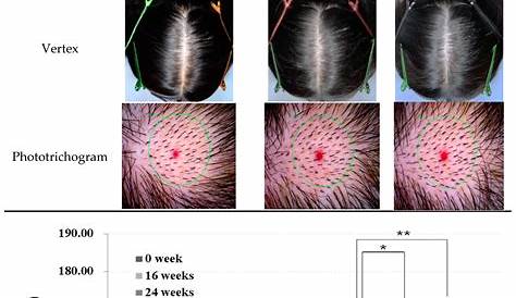Details more than 73 hair density chart men super hot - in.eteachers
