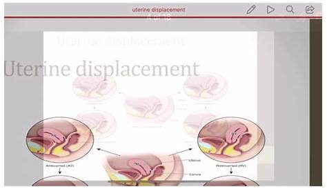 continuous lateral uterine displacement
