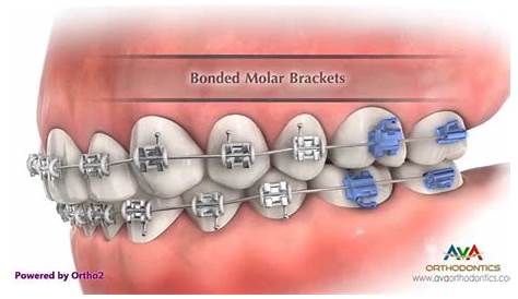 Parts of Braces Part 1 - Orthodontic Treatment - YouTube