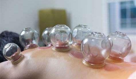Cupping Therapy - Katie Gaffney, OMD, L.Ac.