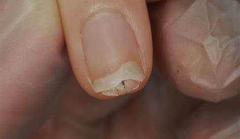 黒い点 清瀬市ネイルサロン 深爪 傷んだ爪 剥離などを健康な爪へ導く yula nail