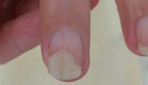 爪 白い 痛み の部分が増える5つの原因と対策をわかりやすく解説します