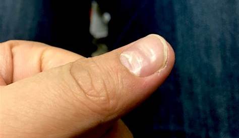 爪 白い 親指 の部分が増える5つの原因と対策をわかりやすく解説します