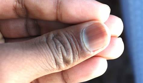 爪 黒い なぜ が真っ黒に！3つの病状の見分けと原因を徹底解説。下血腫と黒色線条とメラノーマ
