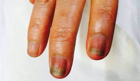 抗がん剤治療中の爪の黒ずみ NPO法人 全国福祉理美容師養成協会