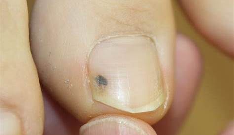 爪 黒い 斑点 足の指のにが。 こんばんは。 足の親指のの中に3ヶ月前からに OKWAVE