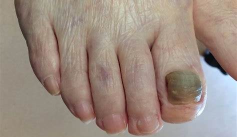 足の親指の爪が黒い｜肥厚爪ケアの事例32 ドクターネイル爪革命®