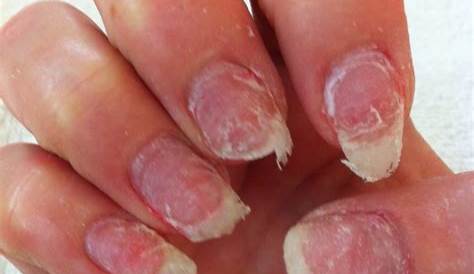 Acrylic Nails Issues Nail Problems Can You Paint Over ?