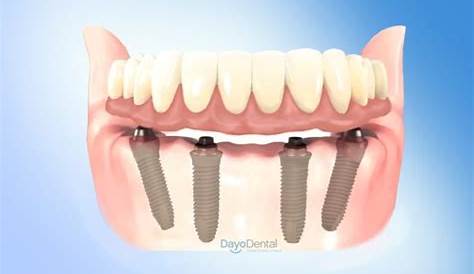 ️ All on 4 Dental Implants in Mexico - All on 4 Mexico Cost 2023