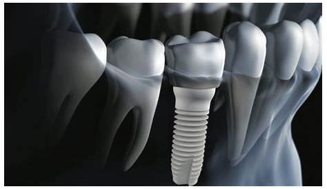 All On 4 Dental Implants in Mexico | 10,800 USD (Per Arch)