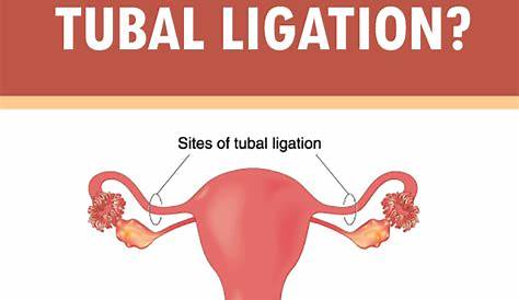 Pregnancy After Tubal Ligation Signs, Symptoms And Risks