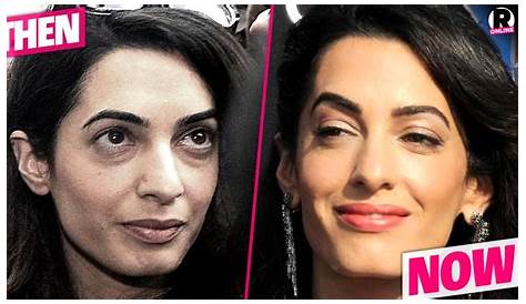 Unveiling The Secrets: Amal Clooney's Plastic Surgery Journey Revealed