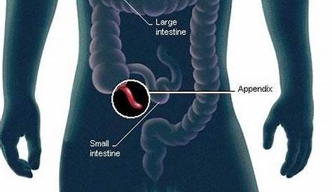 Appendicitis Causes, Pain, Symptoms, Signs & Treatment