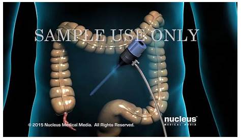 Appendix Removal Surgery Cost SingleIncision Laparoscopic Appendectomy With A Low