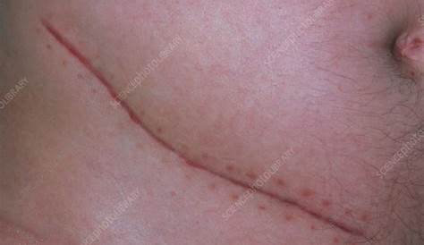 Appendix Removal Surgery Scar Medicina, Cicatriz De Cirugía De Apendicectomía — Fotos De