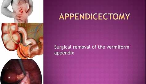 Appendix Surgery Video Free Download PPT Laparoscopic Appendectomy PowerPoint Presentation