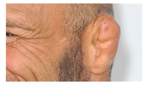 Cauliflower Ear - Symptoms, Causes and Treatment