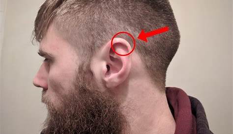 Ear Injury Treatment - Facial Trauma