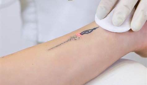Effective Laser Tattoo Removal at Hilton Skin Clinic in Reading