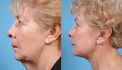 How a Plastic Surgeon Can Eliminate Your Double Chin With an Injection