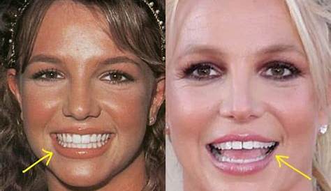 Britney Spears' Dental Odyssey: Discoveries And Insights
