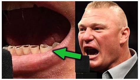 Brock Lesnar Bottom Teeth / What S Wrong With Brock Lesnar S Teeth 10